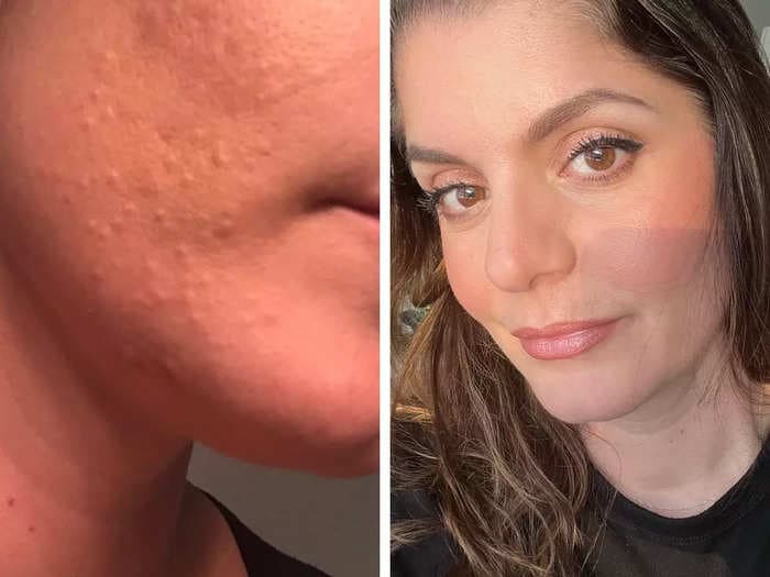 A woman's breakouts were misdiagnosed by multiple dermatologists. The internet helped her realize she had fungal acne.