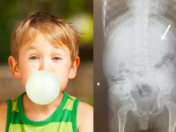 A boy who swallowed a pack of chewing gum ended up in hospital after it got lodged in his stomach