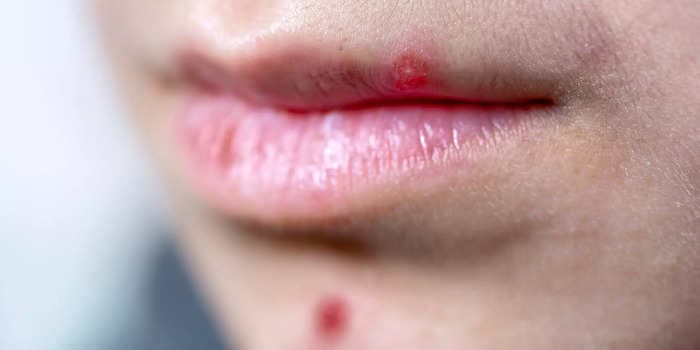 7 tips to make a lip pimple disappear quickly