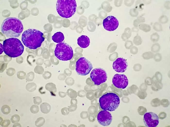 Engineered white blood cells can eliminate cancer, study finds