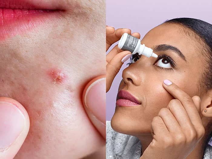 People love this viral hack for using eye drops to conceal acne — but a dermatologist says it's not actually treating the blemishes