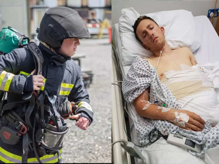 Doctors saved a 20-year-old firefighter's hand by sewing it into his belly. Years later, he's back doing his dream job.