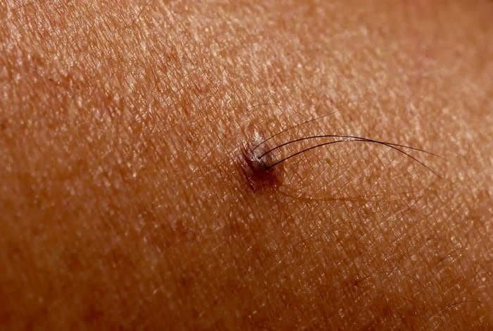 Scientists believe they've discovered a cure for baldness. It's hiding in your hairy moles &mdash; and can be injected like Botox.