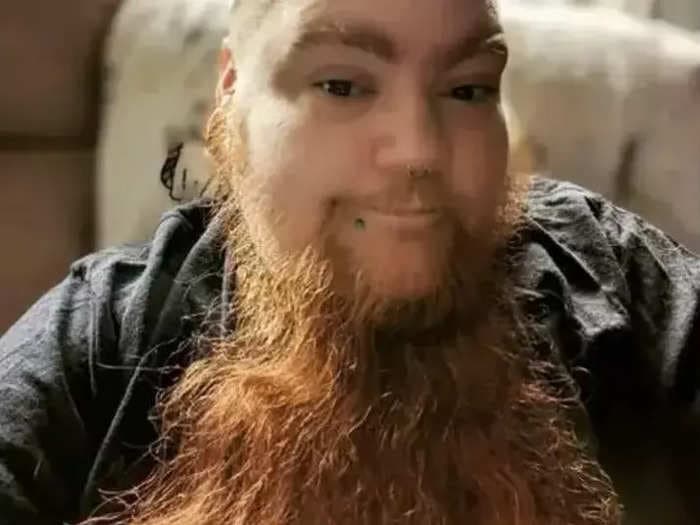 A woman with PCOS broke the Guinness World Record for longest female beard