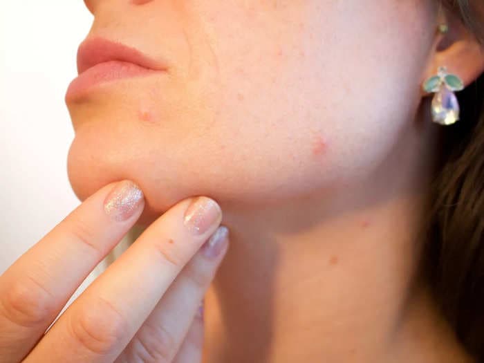 Scientists have genetically tweaked the facial acne-causing bacteria to help fight pimples instead!