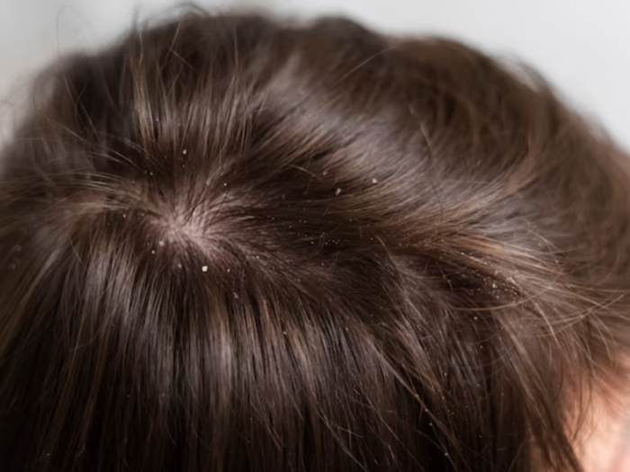 Say goodbye to Dandruff: simple steps for a flake-free scalp