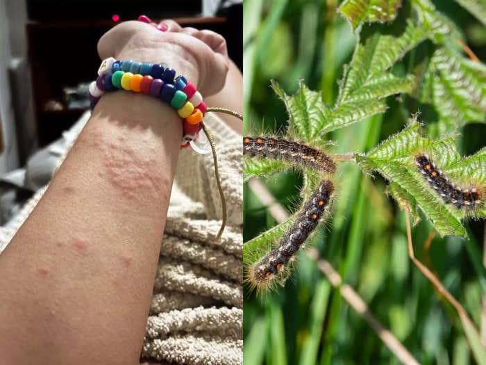 I woke up covered in a painful rash. A caterpillar with toxic hairs was to blame.