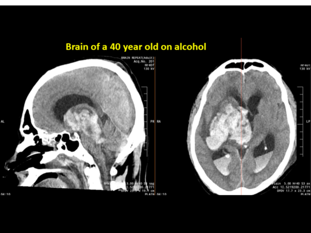 The Liver Doc shares brain scan of 40-year-old on alcohol; highlights link between brain strokes and drinking