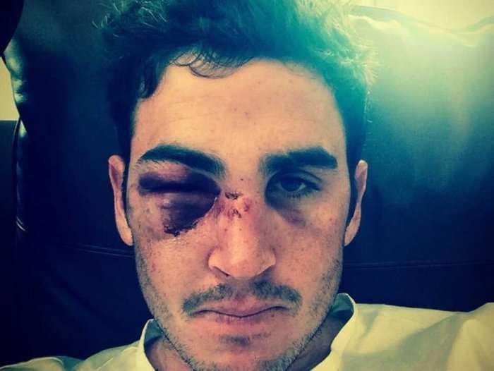 Cricket Player Takes Brutal Photo Of His Face After Freak Injury