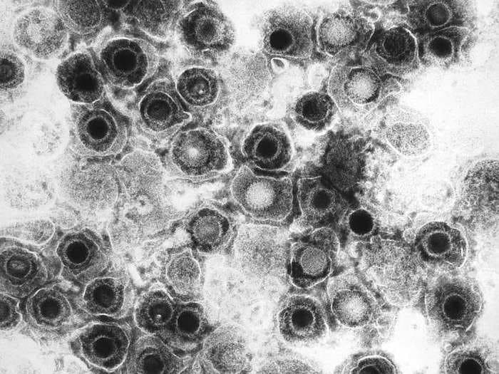 67% of the people on Earth have this 'incurable' viral infection