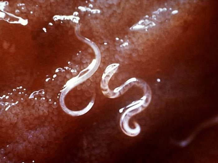 A Canadian couple got infected by hookworm while walking on a beach - here's what to know about the parasites