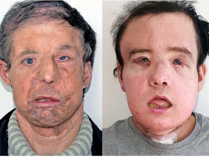 A French man just became the first person ever to receive two face transplants