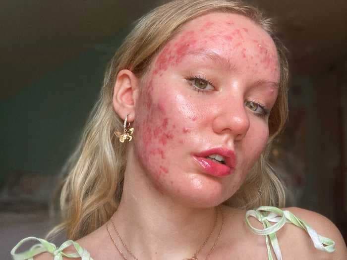 Instagram's 'Blemish Queen' accentuates her pimples in photos to show people 'your acne does not define you'