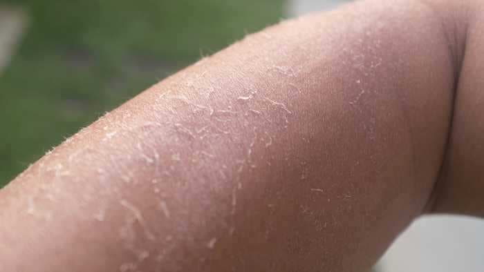 5 ways to get rid of dry skin