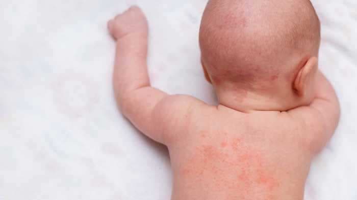 How to identify and treat heat rash in 6 steps