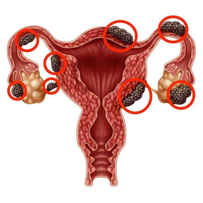 Symptoms of endometriosis and how you can manage the pain