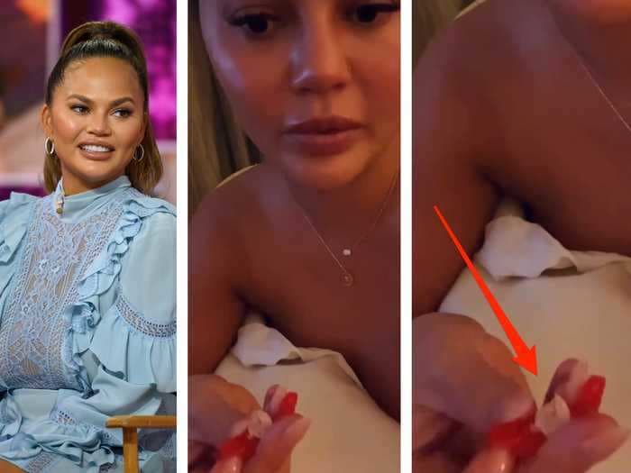 Chrissy Teigen says she lost a tooth while eating a fruit rollup. An expert says 'routine dental care' can prevent that.