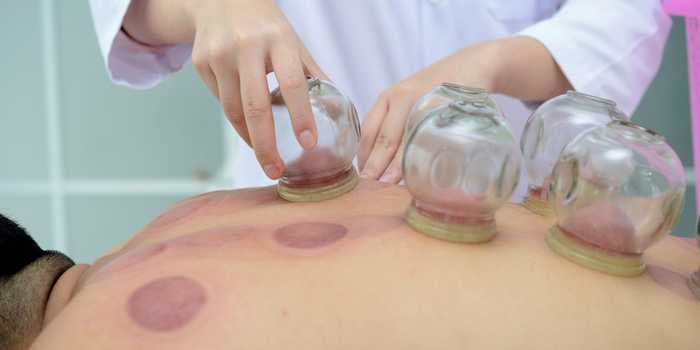 Why cupping therapy is so popular among celebs and athletes - and whether it's right for you