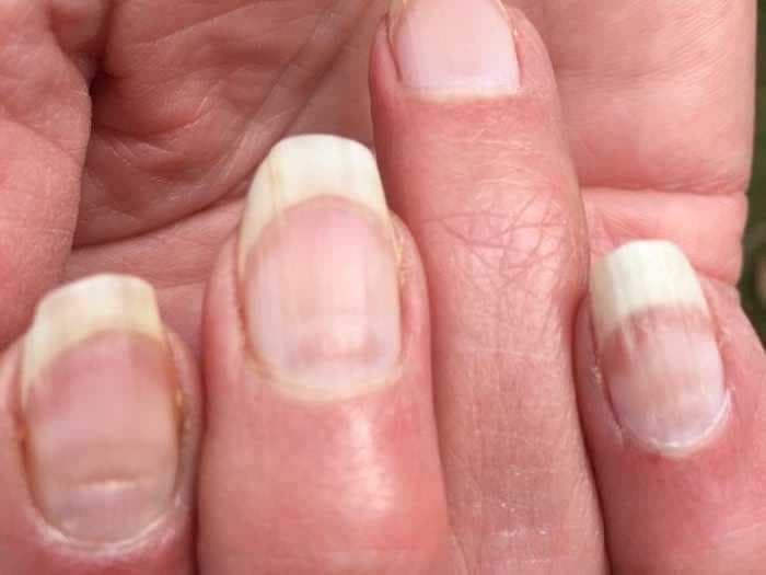 People are getting 'COVID nails,' and one expert says the unusual lines could be as useful as an antibody test to prove previous infection