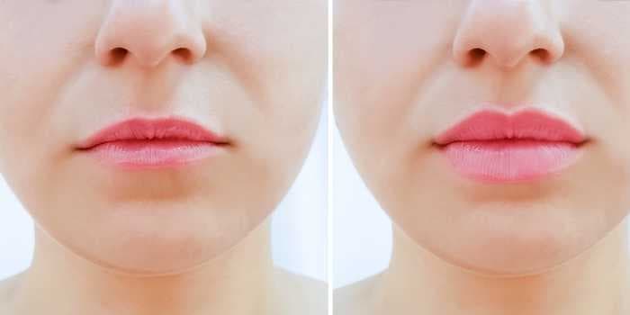 How lip fillers can give you plump, pouty lips and what to expect from the procedure