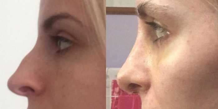 Here's how a $10,000 rhinoplasty procedure can dramatically change your nose