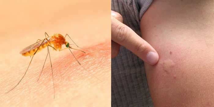 Why mosquito bites itch and 5 home remedies to soothe the pain