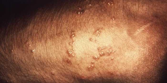 How to spot and treat a poison sumac rash