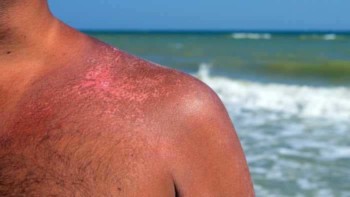 How to get rid of a sunburn fast using easy at-home remedies