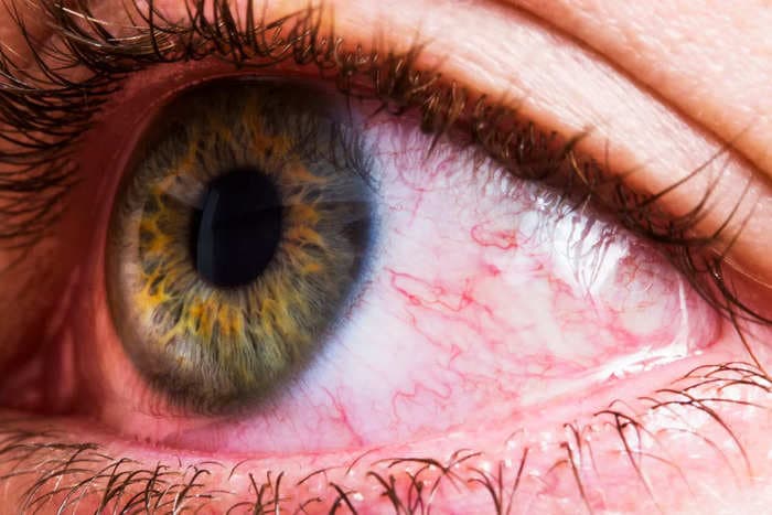 12 reasons why your eyes are red, including eye strain and blepharitis