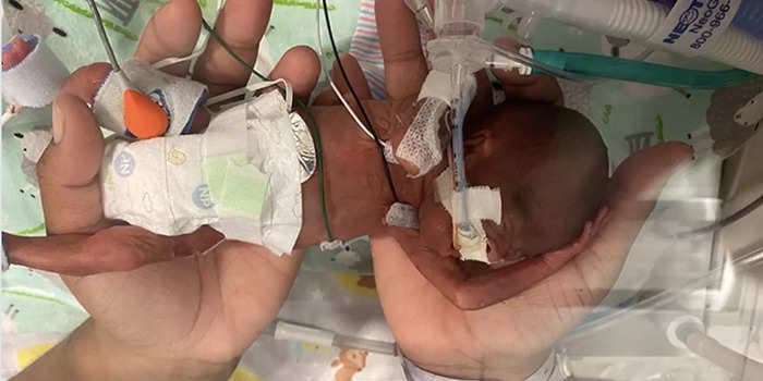 An Alabama baby born at 21 weeks has been certified the most premature in the world