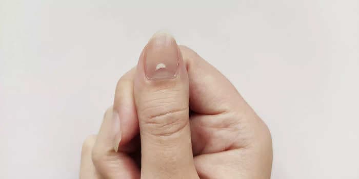 5 reasons why there are white spots on your nails and how to avoid them