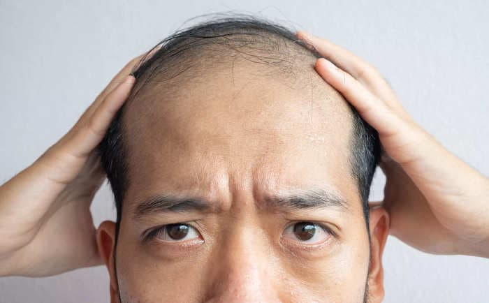 Calling a man 'bald' is sexual harassment, a UK tribunal rules