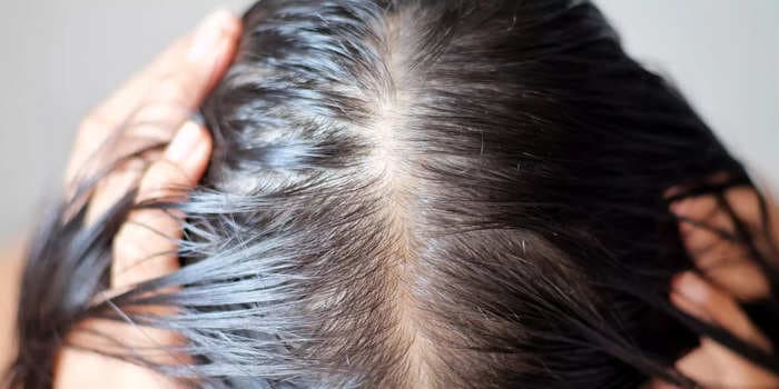 Yes, people with PCOS can lose their hair but there are multiple ways to treat it