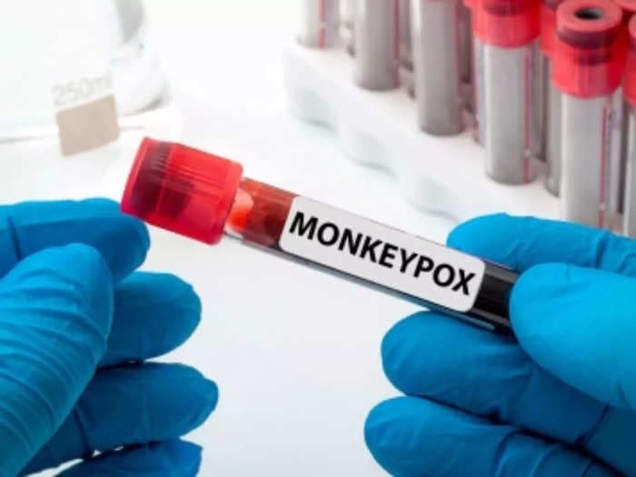 Suspected case of monkeypox in Patna