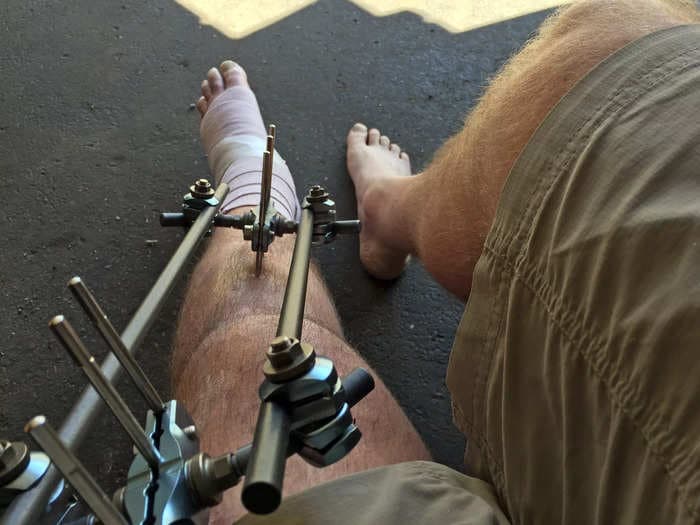 A man borrowed $75,000 for leg-lengthening surgery to make him 3 inches taller, report says