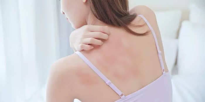 How to tell the difference between eczema and psoriasis and get the right treatment