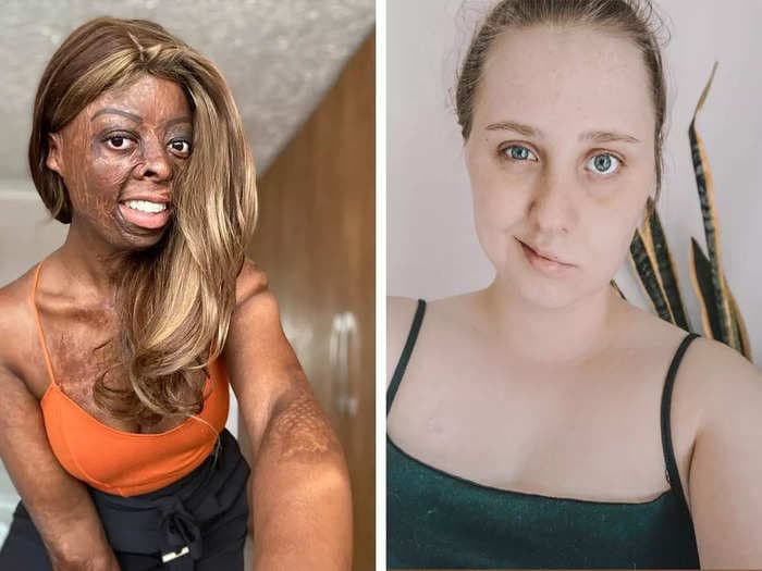 Women with scars, burns, and birthmarks want people to stop acting like their facial differences are 'scary' costumes to replicate on Halloween