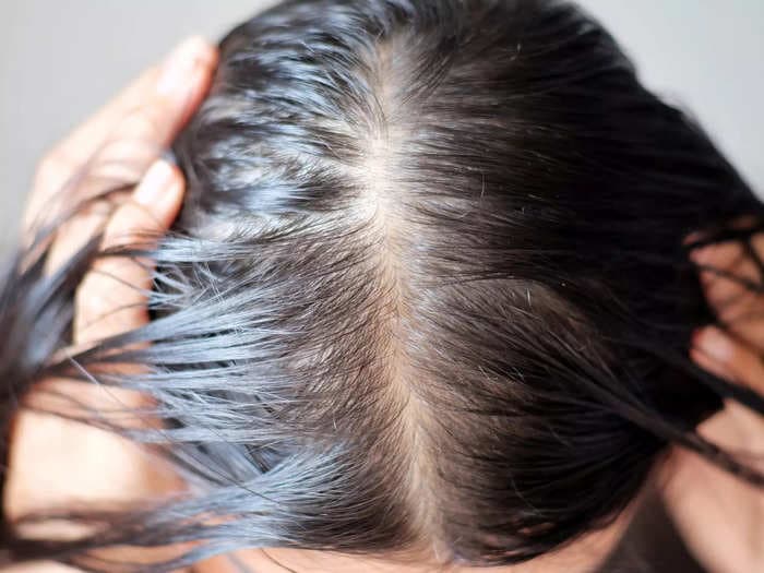 5 surprising things that make your hair fall out, from dry shampoo to PTSD