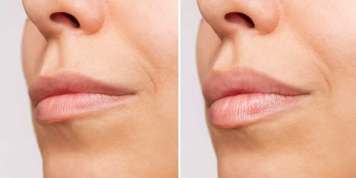 The stages of swelling after lip filler: From bumpy to pouty