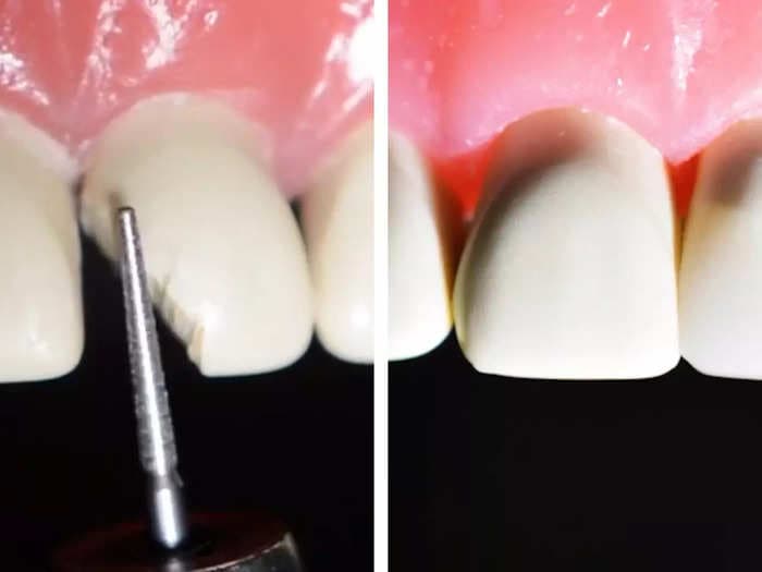 Photos show exactly how a dentist fixes a broken tooth using drills, chemicals, and blue light