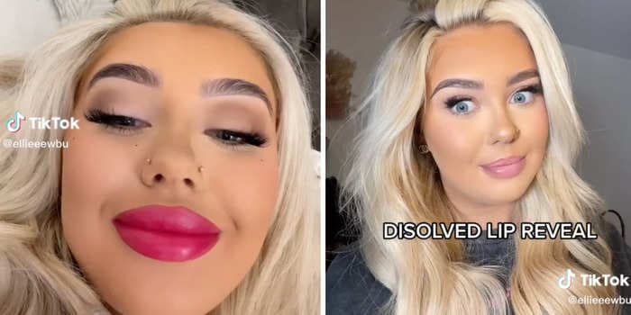 Viewers showered an influencer with compliments after she revealed she regrets getting 'botched' lip filler dissolved: 'All my confidence has gone'