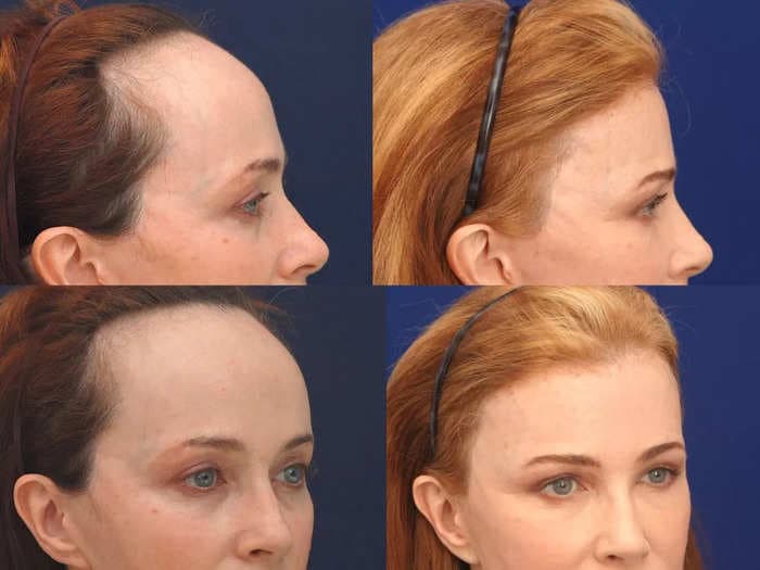A plastic surgeon who performs forehead reduction surgeries to lower hairlines shares before and after photos, and what to expect