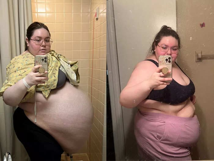 A woman who says doctors dismissed her because of her weight developed an 104-pound ovarian tumor