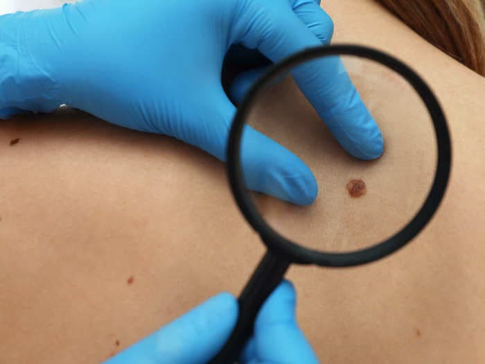 Dermatologists found the 'world's smallest skin cancer' under a woman's eye — it was smaller than the tip of a pen