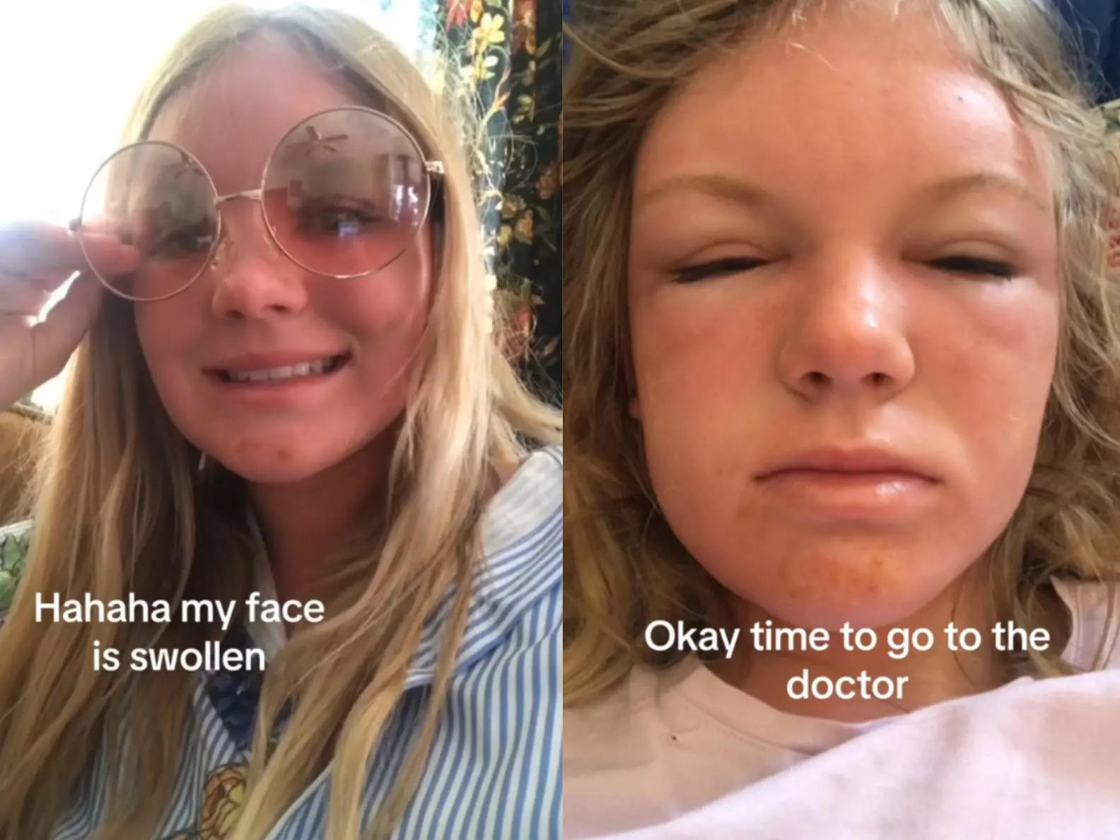 a-woman-s-horrific-sunburn-is-teaching-people-about-sun-poisoning-and