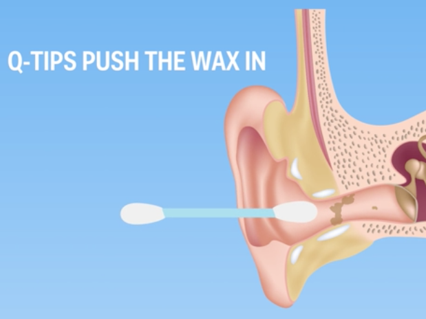 why-you-shouldn-t-use-q-tips-to-clean-out-earwax-and-what-you-should