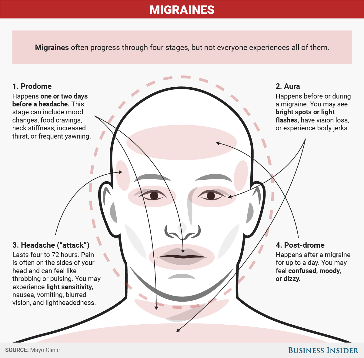 Not all headaches hurt the same - here's how to know what type of pain ...