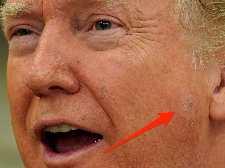 Photos Of A A Scaly Discolored Patch Of Skin On Trump s Face Have Gone 