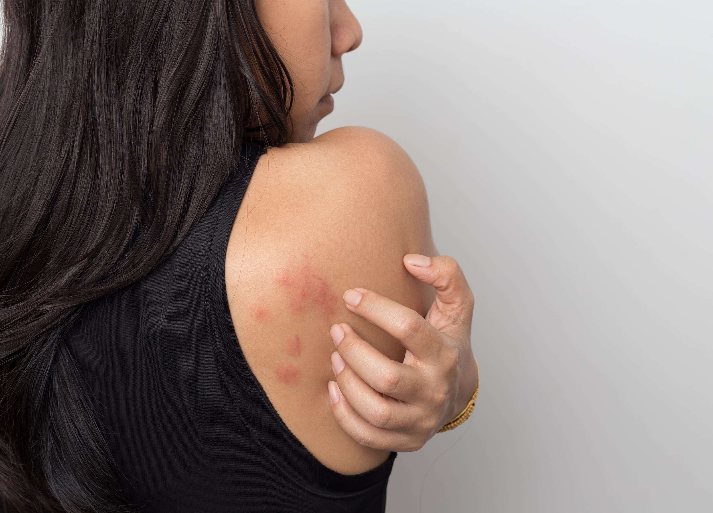 can-you-be-allergic-to-water-aquagenic-urticaria-is-a-rare-condition-business-insider-india