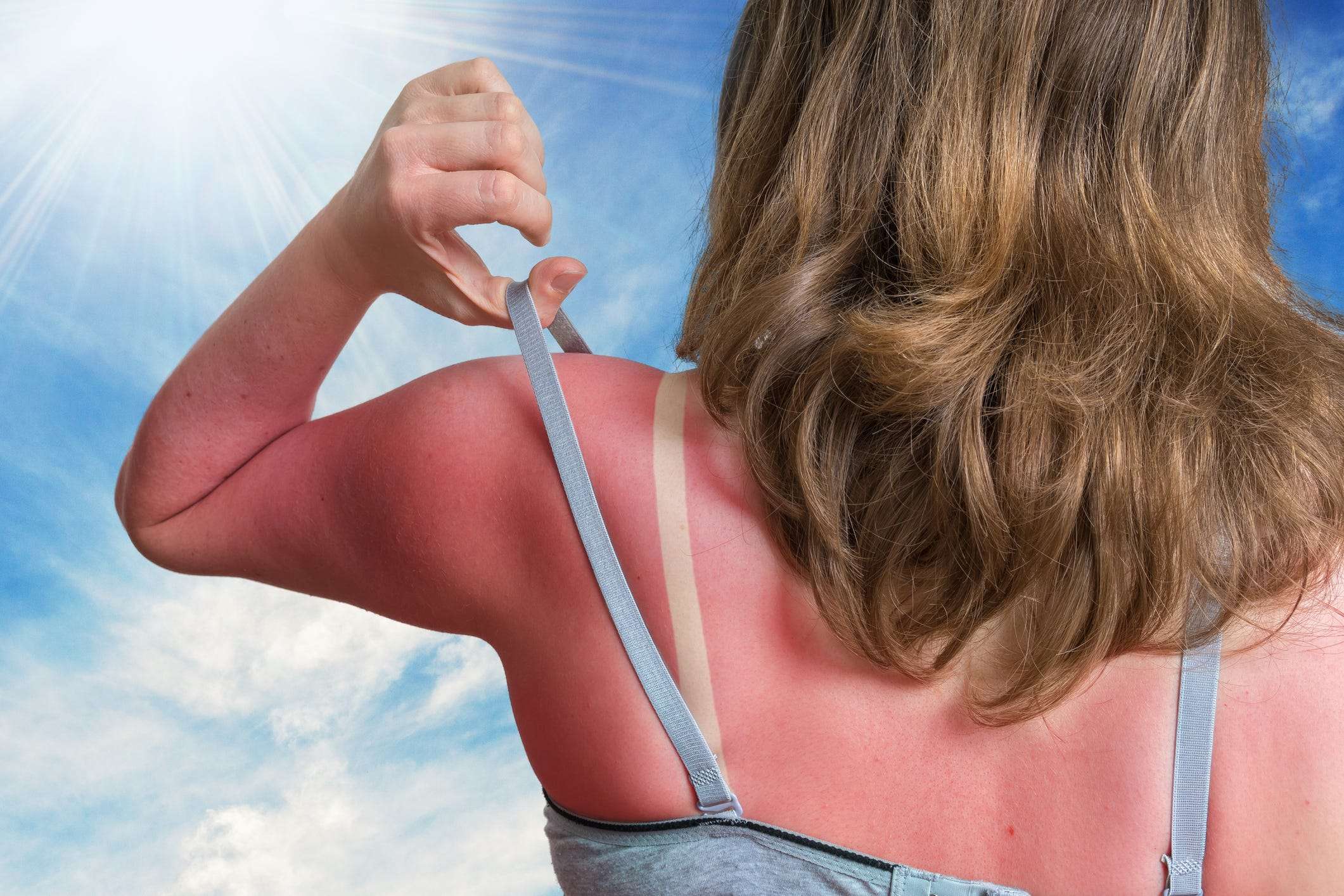 what-is-sun-poisoning-and-what-makes-it-different-from-sunburn